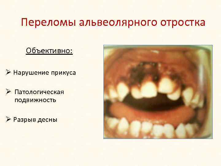 Переломы альвеолярного отростка Объективно: Ø Нарушение прикуса Ø Патологическая подвижность Ø Разрыв десны 