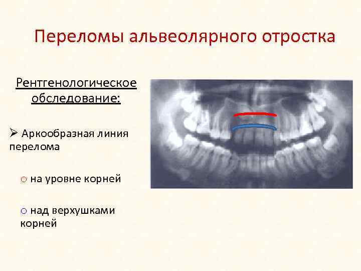 Переломы верхней челюсти у детей презентация