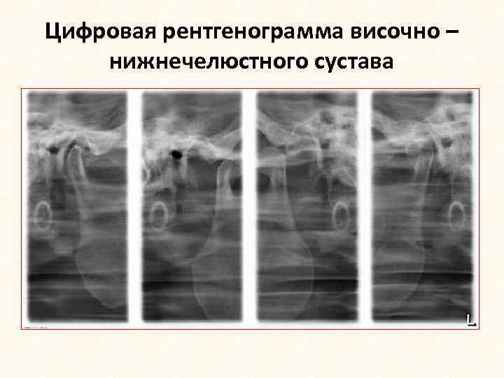 Цифровая рентгенограмма височно – нижнечелюстного сустава 
