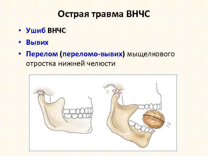 Острая травма ВНЧС • Ушиб ВНЧС • Вывих • Перелом (переломо-вывих) мыщелкового отростка нижней