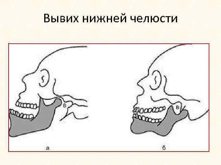 Вывих нижней челюсти 