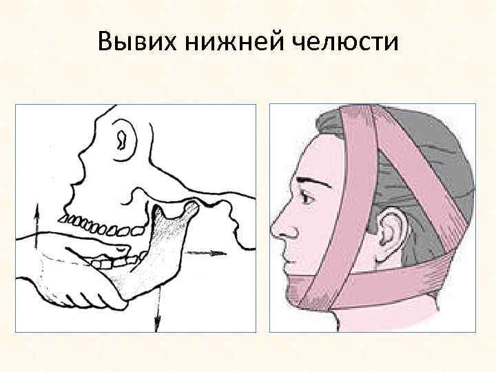 Вывих нижней челюсти 