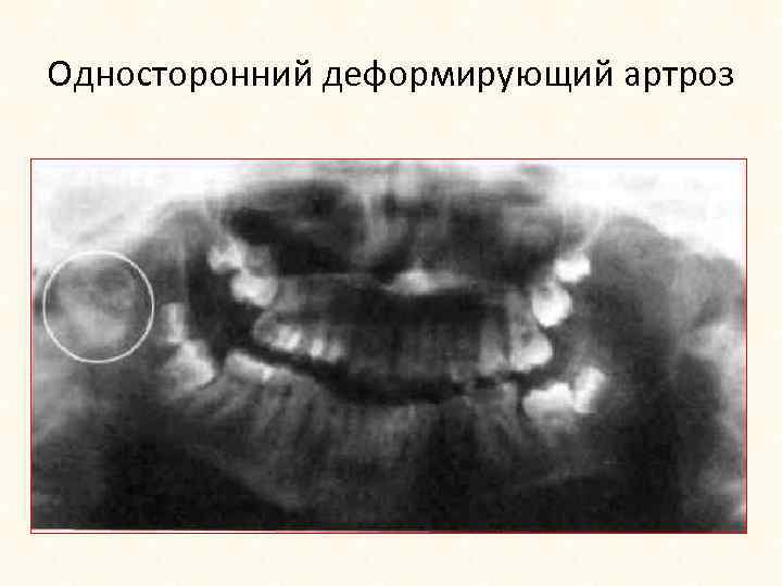 Односторонний деформирующий артроз 