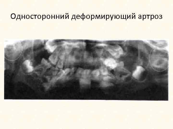 Односторонний деформирующий артроз 