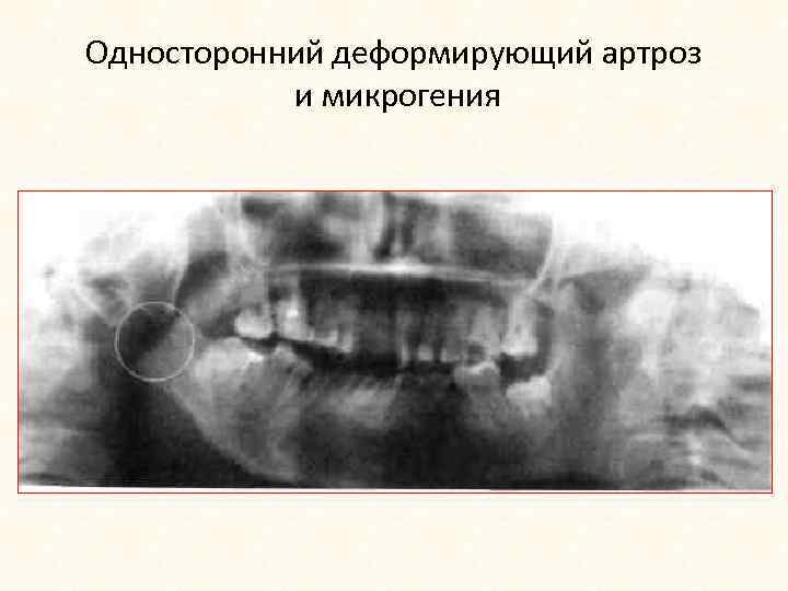 Односторонний деформирующий артроз и микрогения 