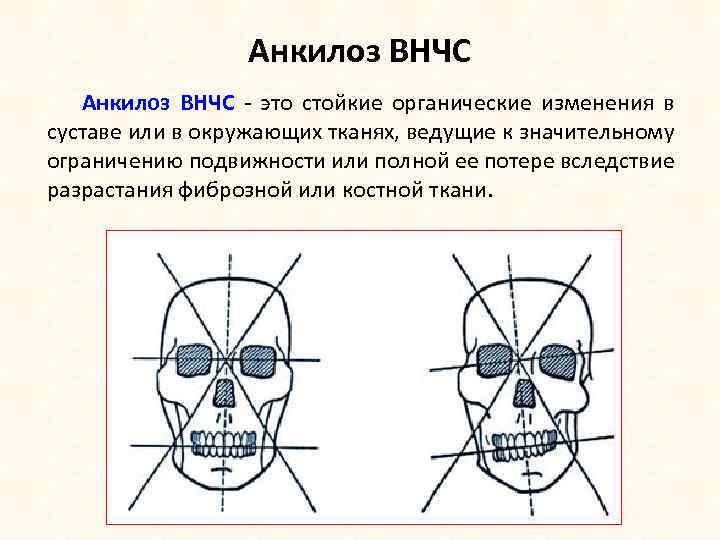 Анкилоз ВНЧС - это стойкие органические изменения в суставе или в окружающих тканях, ведущие