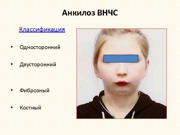 Анкилоз ВНЧС Классификация • Односторонний • Двусторонний • Фиброзный • Костный 