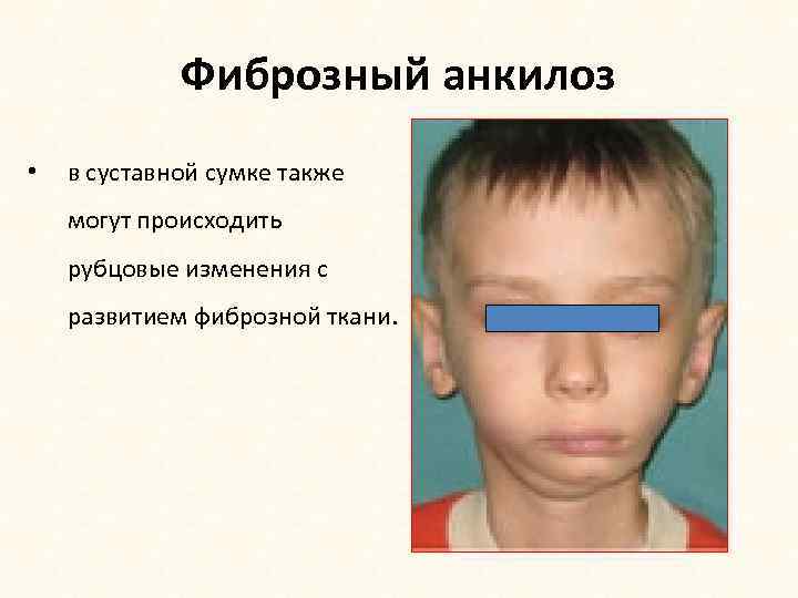 Фиброзный анкилоз • в суставной сумке также могут происходить рубцовые изменения с развитием фиброзной