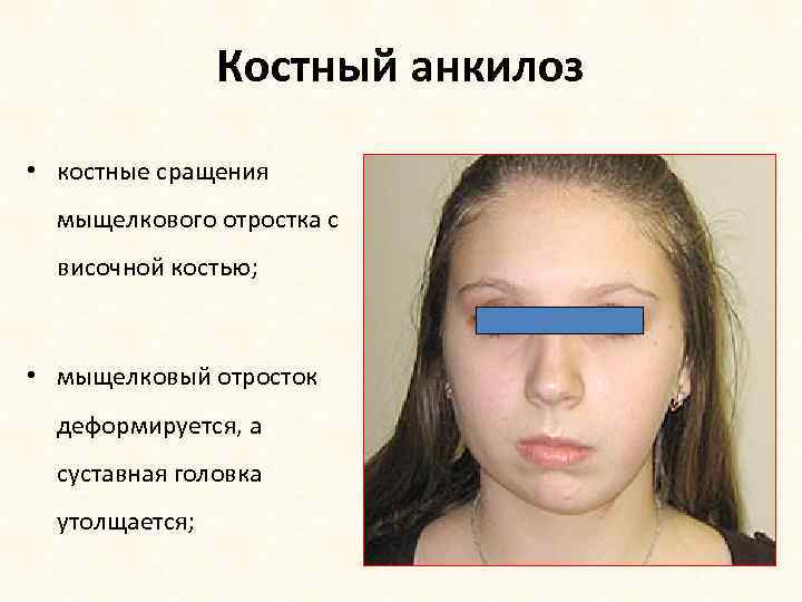 Костный анкилоз • костные сращения мыщелкового отростка с височной костью; • мыщелковый отросток деформируется,
