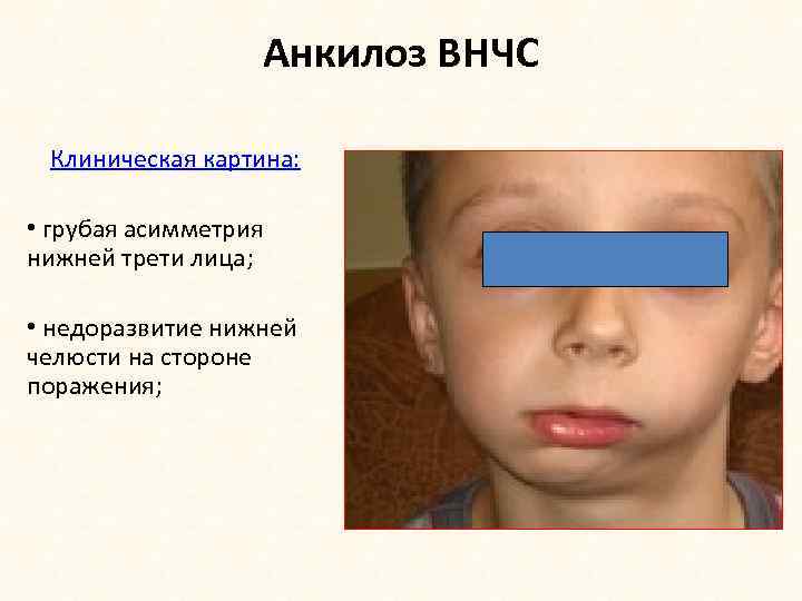 Анкилоз ВНЧС Клиническая картина: • грубая асимметрия нижней трети лица; • недоразвитие нижней челюсти