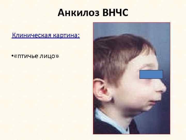 Анкилоз ВНЧС Клиническая картина: • «птичье лицо» 