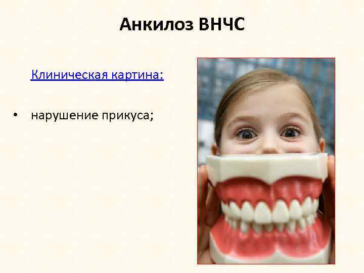 Анкилоз ВНЧС Клиническая картина: • нарушение прикуса; 
