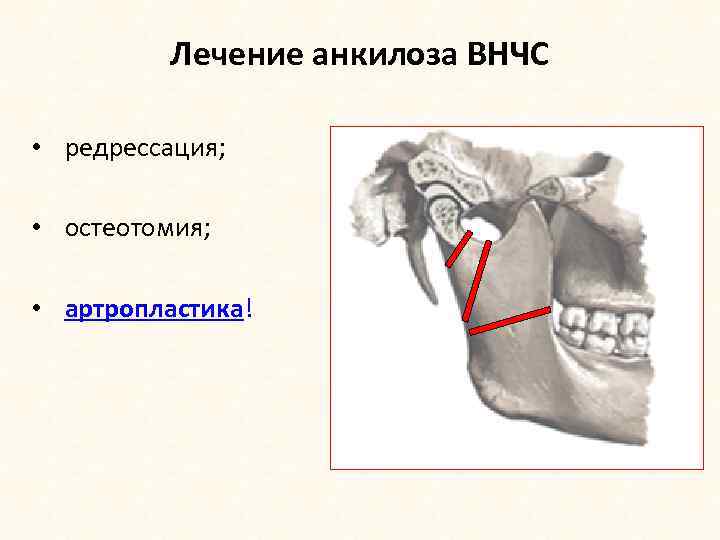 Контрактура нижней челюсти презентация