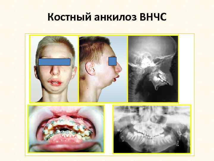 Костный анкилоз ВНЧС 