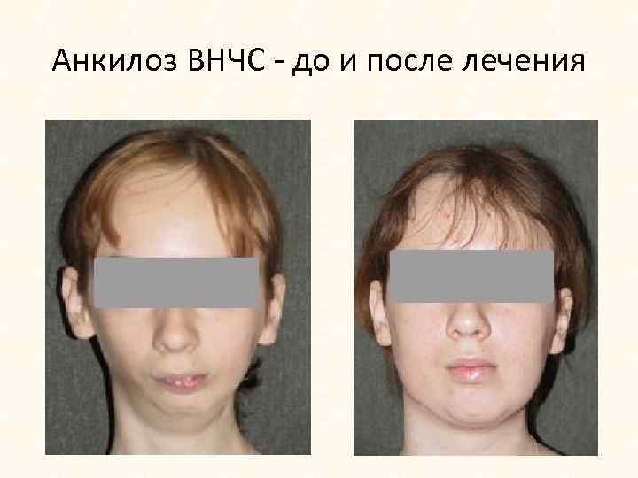Анкилоз ВНЧС - до и после лечения 