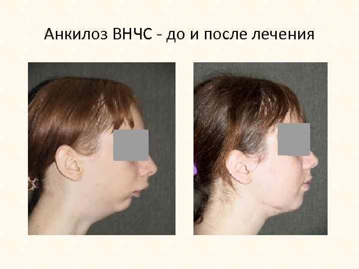 Анкилоз ВНЧС - до и после лечения 