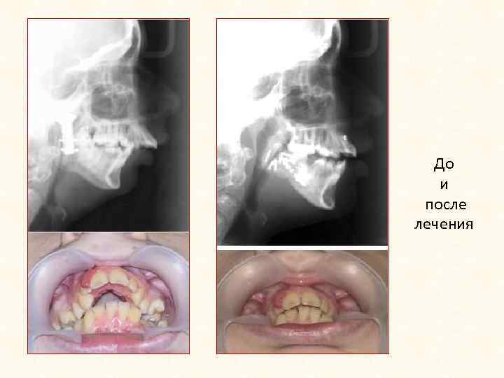 До и после лечения 