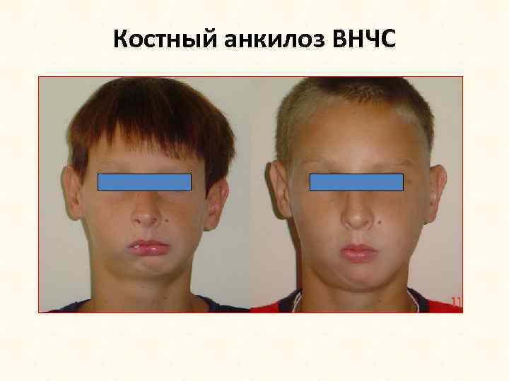 Костный анкилоз ВНЧС 