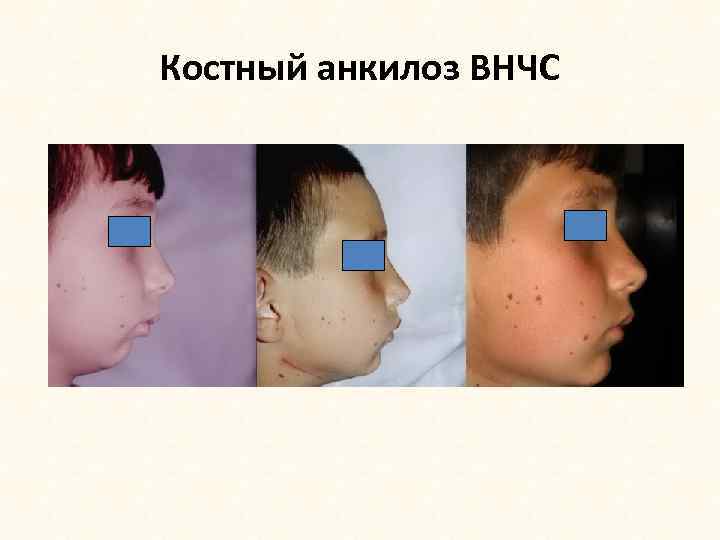 Костный анкилоз ВНЧС 