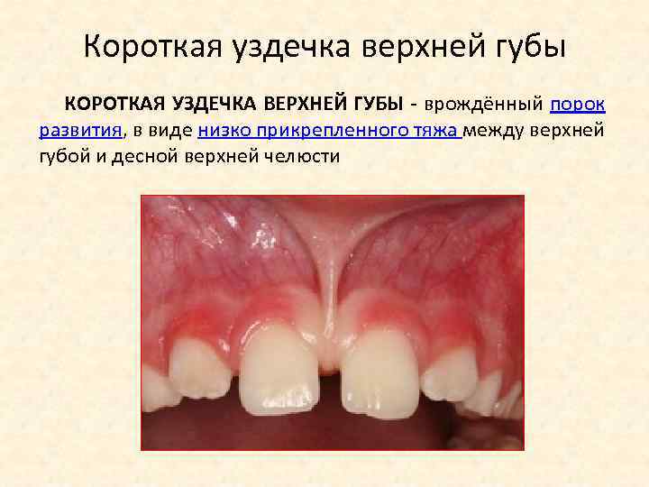 Короткая уздечка верхней губы КОРОТКАЯ УЗДЕЧКА ВЕРХНЕЙ ГУБЫ - врождённый порок развития, в виде