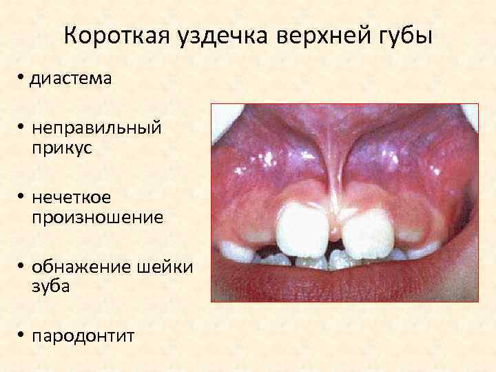 Короткая уздечка верхней губы • диастема • неправильный прикус • нечеткое произношение • обнажение