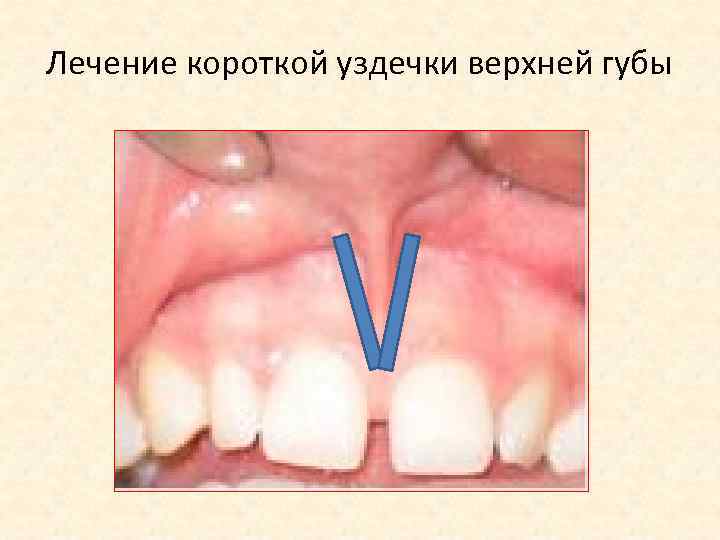 Лечение короткой уздечки верхней губы 