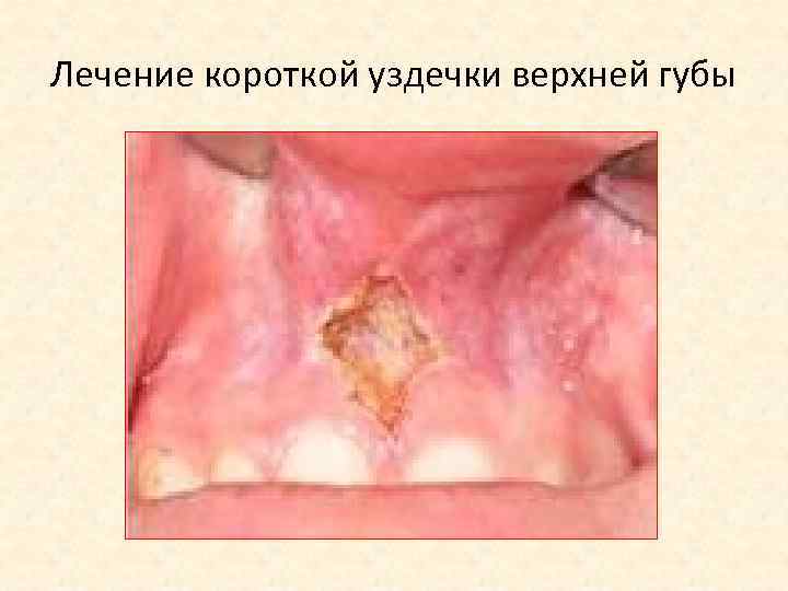 Лечение короткой уздечки верхней губы 