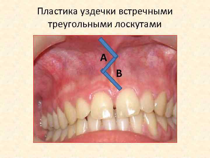 Пластика уздечки встречными треугольными лоскутами А В 