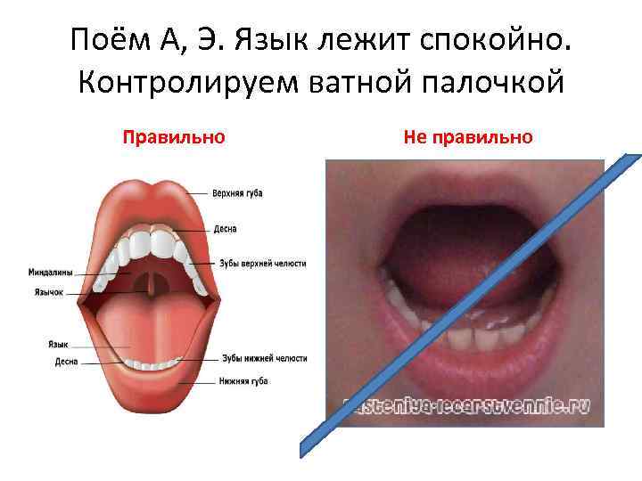 Поём А, Э. Язык лежит спокойно. Контролируем ватной палочкой Правильно Не правильно 