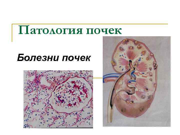 Патология почек. Почечная патология заболевания. Патологии почек презентация.