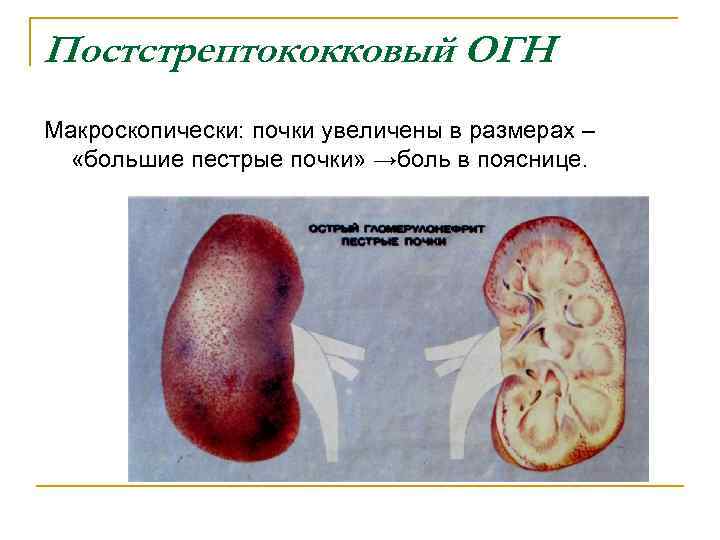 Постстрептококковый ОГН Макроскопически: почки увеличены в размерах – «большие пестрые почки» →боль в пояснице.