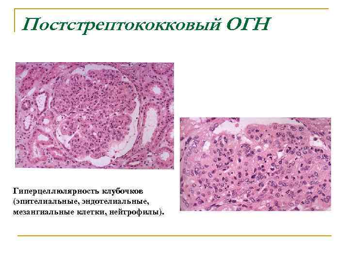 Постстрептококковый ОГН Гиперцеллюлярность клубочков (эпителиальные, эндотелиальные, мезангиальные клетки, нейтрофилы). 