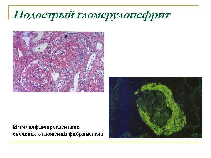 Подострый гломерулонефрит Иммунофлюоресцентное свечение отложений фибриногена 