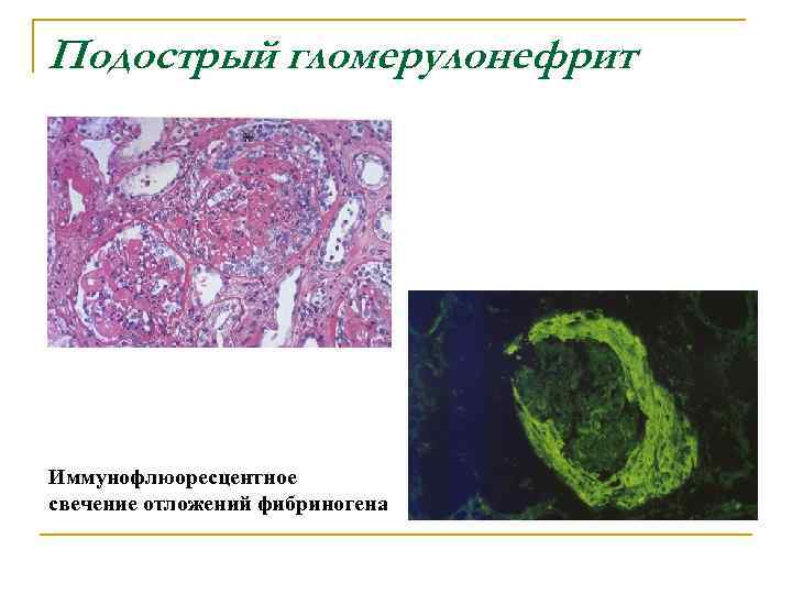 Клиническая картина острого гломерулонефрита