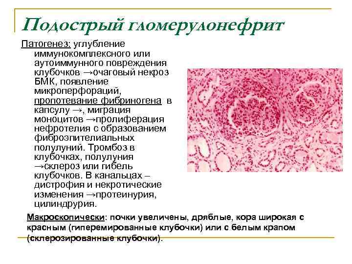 Подострый гломерулонефрит Патогенез: углубление иммунокомплексного или аутоиммунного повреждения клубочков →очаговый некроз БМК, появление микроперфораций,