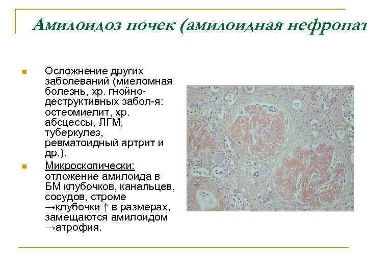 Амилоидоз почек (амилоидная нефропат n n Осложнение других заболеваний (миеломная болезнь, хр. гнойнодеструктивных забол-я: