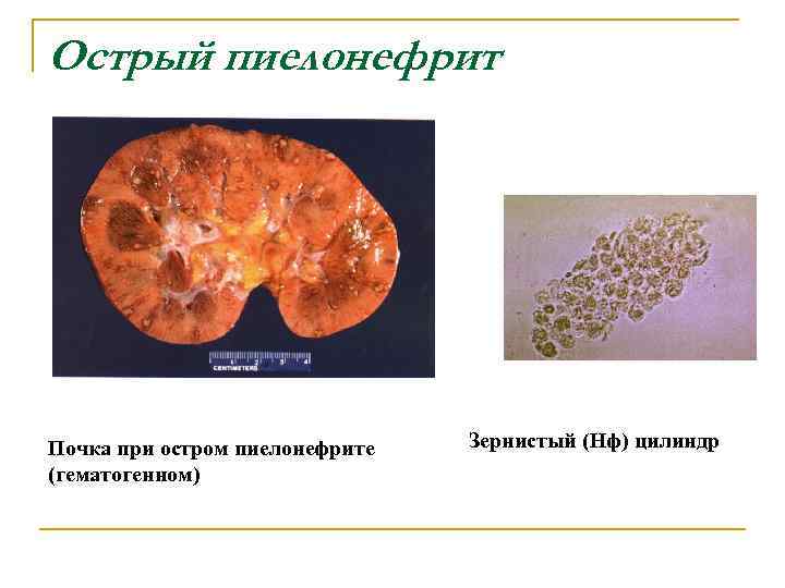 Острый пиелонефрит Почка при остром пиелонефрите (гематогенном) Зернистый (Нф) цилиндр 