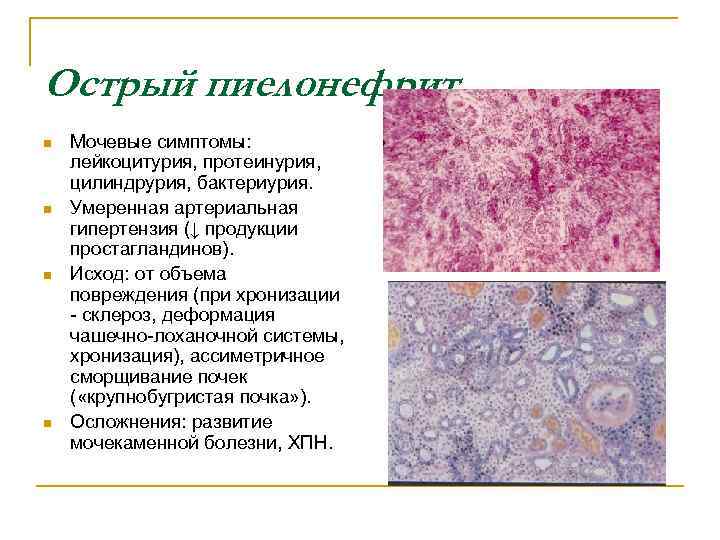 Острый пиелонефрит n n Мочевые симптомы: лейкоцитурия, протеинурия, цилиндрурия, бактериурия. Умеренная артериальная гипертензия (↓