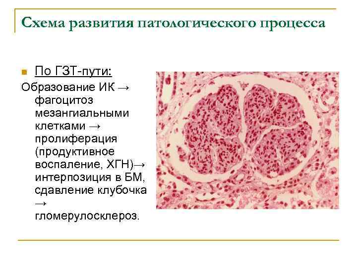 Схема развития патологического процесса n По ГЗТ-пути: Образование ИК → фагоцитоз мезангиальными клетками →