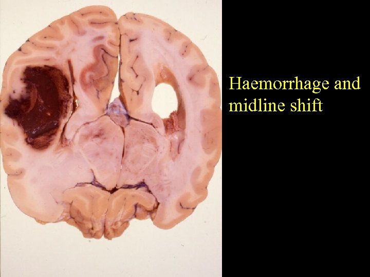 Haemorrhage and midline shift 