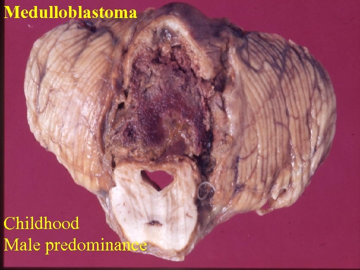 Medulloblastoma Childhood Male predominance 