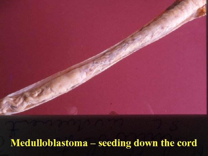 Medulloblastoma – seeding down the cord 