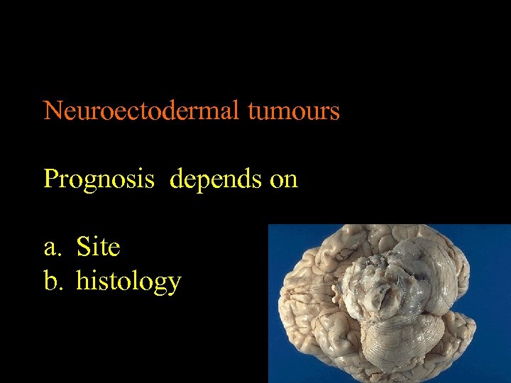 Neuroectodermal tumours Prognosis depends on a. Site b. histology 