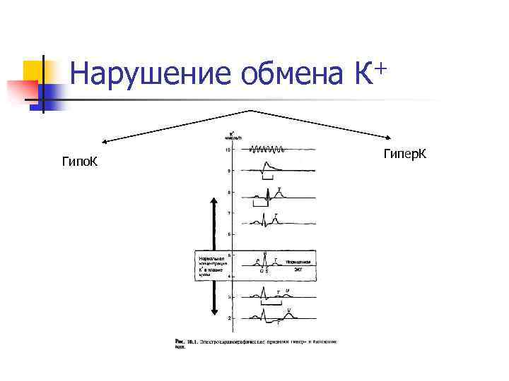 Нарушение обмена К+ Гипо. К Гипер. К 