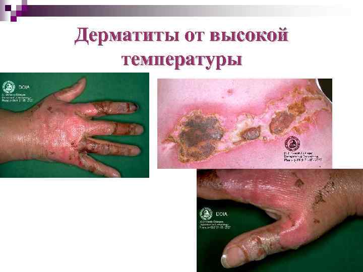 Дерматиты от высокой температуры 