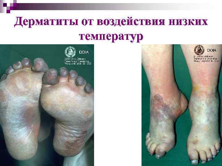 Дерматиты от воздействия низких температур 