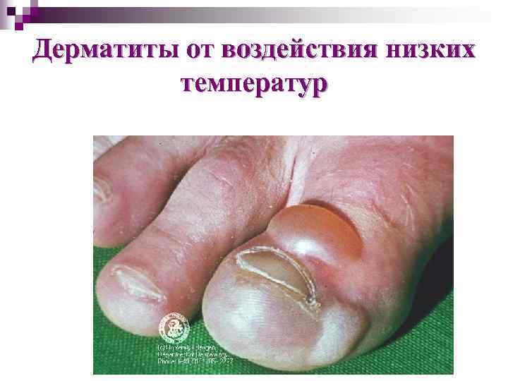 Дерматиты от воздействия низких температур 