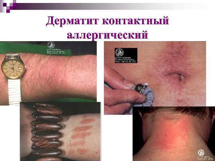 Дерматит контактный аллергический 