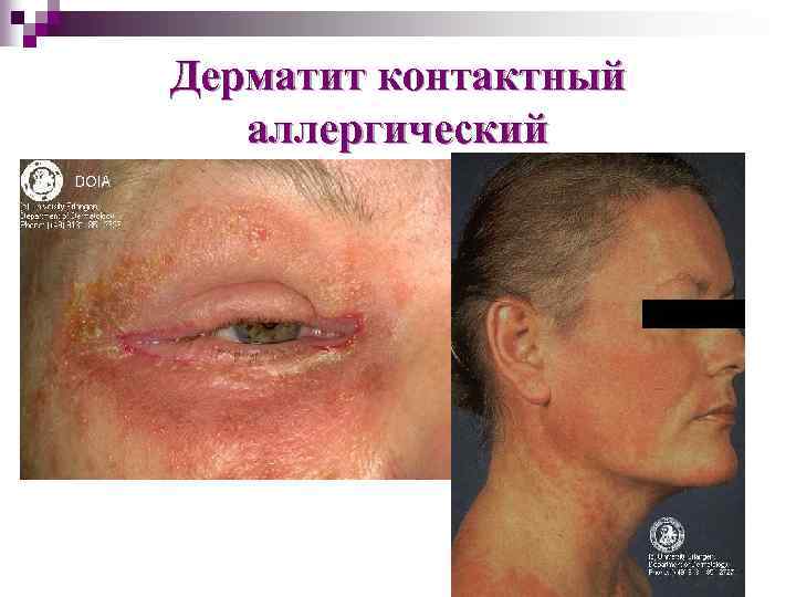 Дерматит контактный аллергический 