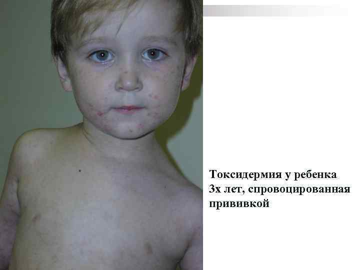 Токсидермия у ребенка 3 х лет, спровоцированная прививкой 